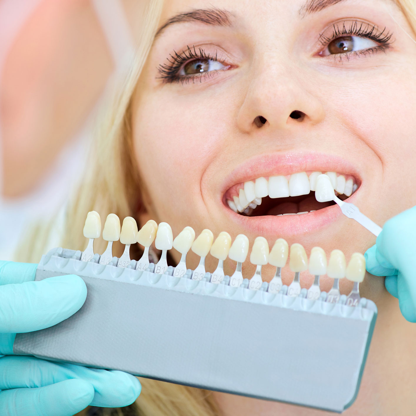 clínica dental en Aluche, dentista en Aluche, estética dental en Aluche, carillas dentales ultrafinas en Aluche, blanqueamiento dental en Aluche, aumento de volumen labial en Aluche.