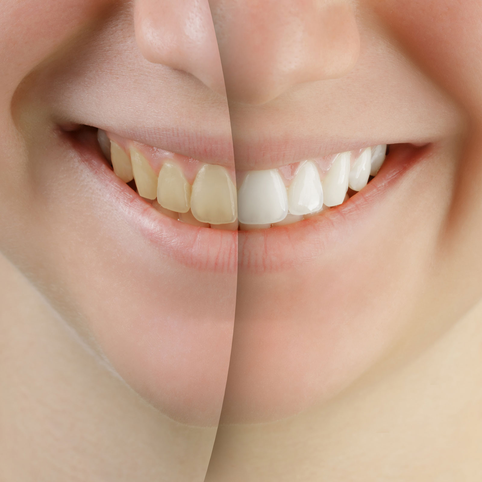 clínica dental en Aluche, dentista en Aluche, estética dental en Aluche, carillas dentales ultrafinas en Aluche, blanqueamiento dental en Aluche, aumento de volumen labial en Aluche.