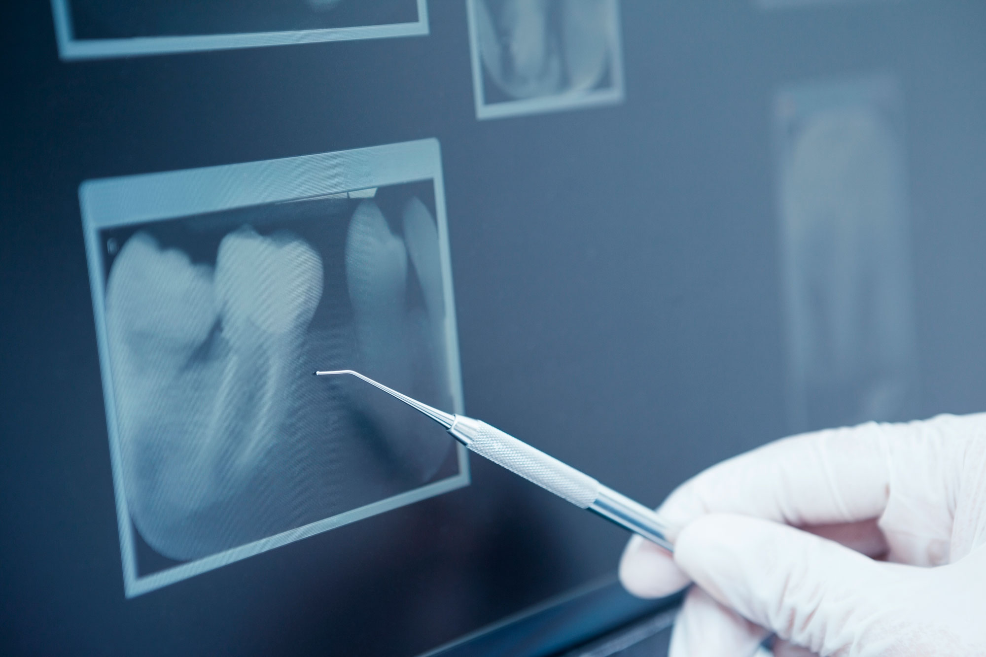 clínica dental en Aluche, dentista en Aluche, endodoncia en Aluche.